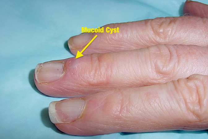 how-do-i-get-rid-of-a-mucous-cyst-on-my-finger-mastery-wiki